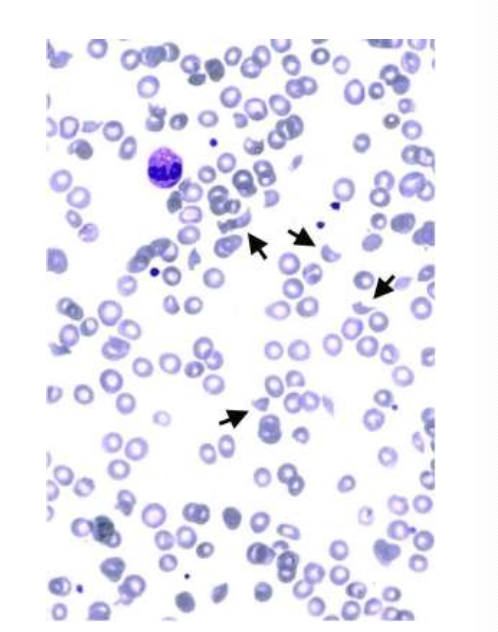 <p>Variable</p><p>Regen or non regen anemia </p><p>Thrombocytopenia </p><p>Leukopenia followed by a leukocytosis </p>