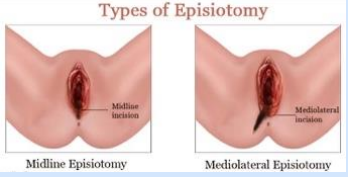 <p>Purposeful laceration of the vaginal opening to facilitate delivery by enlarging the vaginal outlet</p><p>-Can be midline (MC, easier to repair) or mediolateral (away from anus). ACOG recommends against routine use of episiotomy due to risk of perineal laceration </p><p>-Complications: infection, hematoma, cellulitis, dehiscence, abscess, dyspareunia, altered sexual function, perineal pain, incontinence, fistula, pudendal nerve conduction, necrotizing fasciitis </p>