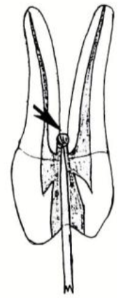 <p>What critical error can occur if your coronal access isn’t big enough and too deep in a maxillary premolar?</p>