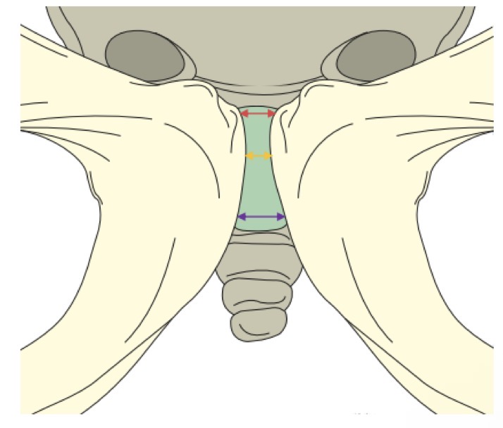 <p>VRAI : plus large en haut et en avant</p>