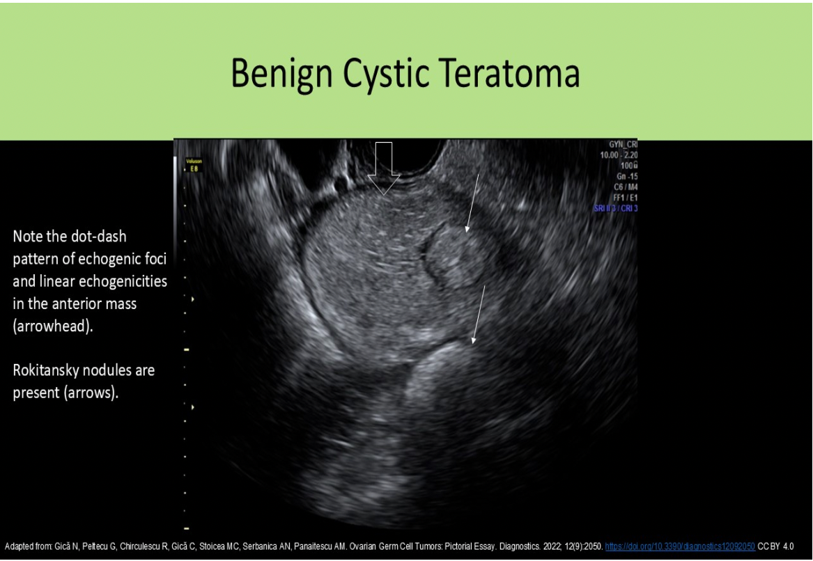 <p>D. cystic teratoma</p><p>A Rokitansky nodule is another term used to describe the dermoid plug.</p>