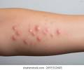 <p>Raised, itchy, or stinging areas of skin that are often redder or paler than the surrounding skin. </p><ul><li><p>They are a classic sign of an allergic reaction, insect bite, or inflammatory response</p></li></ul><p></p>