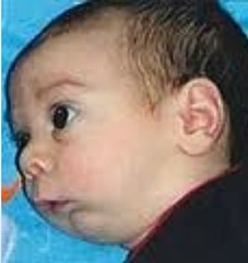 <p>A series of birth defects that result from underdevelopment of the lower jaw. Micrognathia, glossoptosis, cleft palate, airway obstruction. Requires emergent management in the NICU to ensure tongue will not fall backwards, occluding the airway.</p>