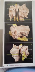 <p>disarticulated</p>