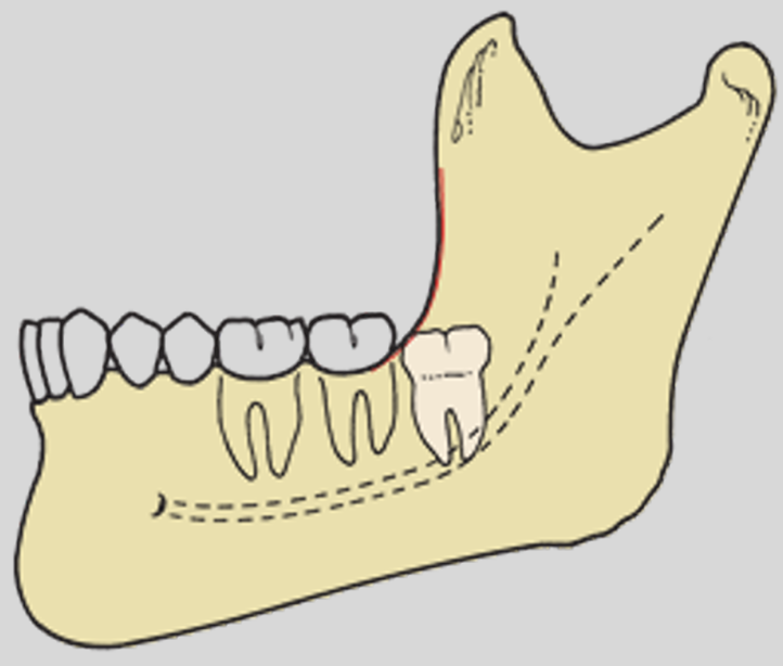<p>the crown is covered entirely by the anterior border of the ramus</p>