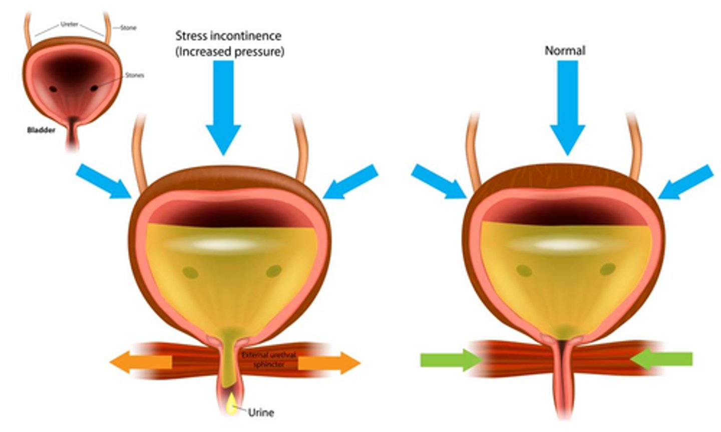 <p>B) Increased intra-abdominal pressure forcing urine through the urinary sphincter, more common in women, often triggered by activities like coughing, lifting, sneezing, laughing, and pregnancy</p>