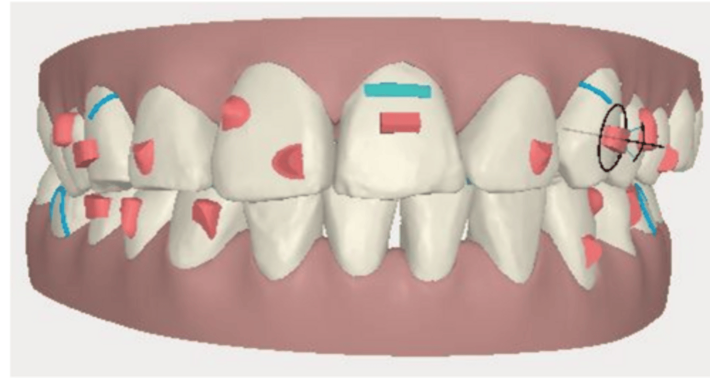 <p>What do the red shapes represent in ClinCheck?</p>