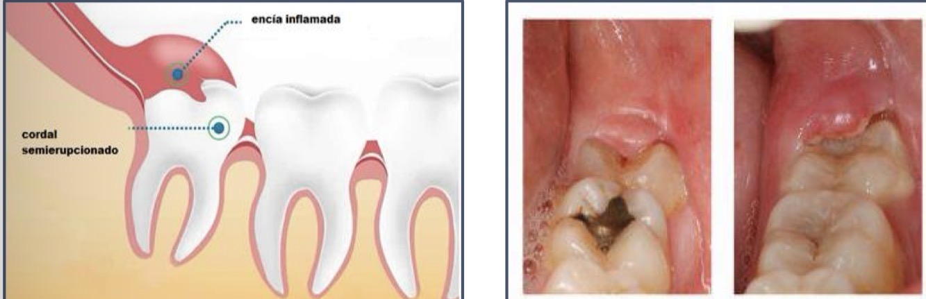 <p>Inflammation of gum and/or alveolar mucosa of partially erupted tooth- mainly in L3M- operculum </p><p>Swollen, suppurating, painful red lesion- halitosis, sensitive to touch, may interfere with mouth closure, extraoral swelling in corner, lymohoadenopathy, fever sometimes</p><p>ATB therapy, systemic anyipyretics, antiseptic mouthwash- no antibiotics unless fever </p>