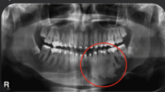 <p>How is this lesion described in terms of internal structure?</p>