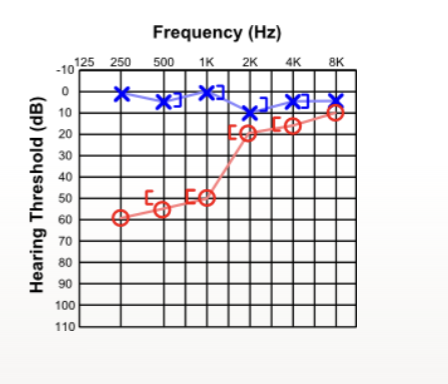 <p>what type of hearing loss</p>