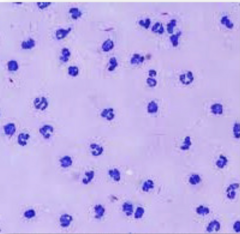 <p>a common joint disease that is consistent with this cytology</p>
