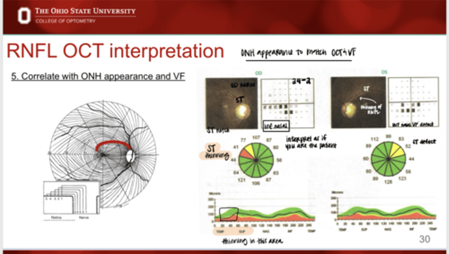 <p>Should you correlate the ONH appearance to the VF?</p>