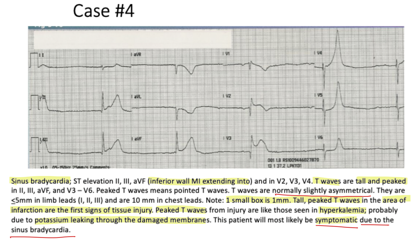 <p><strong><em>Symptomatic</em></strong> <strong>bradycardia</strong> leading to <em>dizziness</em> due to r<em>educed oxygen delivery to the brain</em></p><p></p><ul><li><p><span><strong>What Happens:</strong> An 87-year-old presents with dizziness and extreme fatigue. Her pulse is dangerously slow (<strong>P=30</strong>). The ECG shows ST elevation in leads <strong>II, III, aVF, and V2–V4</strong>, along with <strong>tall, peaked T waves</strong>.</span></p></li><li><p><span><strong>Logic:</strong> The patient has an extensive MI covering both the inferior and anterior walls. The <strong>tall, peaked T waves</strong> are the first sign of tissue injury.</span></p></li><li><p><span><strong>Association:</strong></span></p><ul><li><p><span><strong>Ionic Cause:</strong> These peaked T waves occur because <strong>potassium leaks through damaged cell membranes</strong>, mimicking hyperkalemia in the local area of injury.</span></p></li><li><p><span><strong>Symptomatic Bradycardia:</strong> The patient's dizziness is logically associated with the severe <strong>sinus bradycardia</strong> (P=30), which drastically reduces oxygen delivery to the brain.</span></p></li></ul></li></ul><p></p>