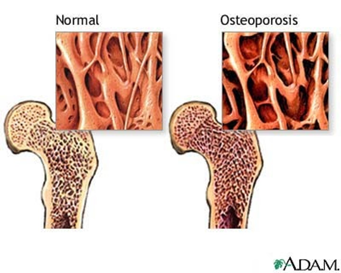 <p>• Decreased bone mineral density</p><p>• Osteoclasts have gone crazy</p><p>• Breaking down bone matrix</p><p>• One potential Cause: parathyroid hormone going crazy</p><p>• Another cause: not enough calcium</p><p>• Chronic renal failure: since liver cant activate vitamin D cant absorb calcium</p><p>• White women most at risk</p><p>• Multifactorial</p><p>• Menopause is a big risk factor: when you go into menopause, estrogen is a protective factor of osteoblasts, so when we lose that estrogen, the osteoblasts aren't protected anymore</p><p>• At risk for fractures easily</p>