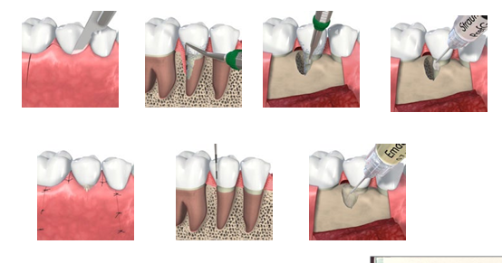 <p>-harvest from porcine teeth</p><p>-contains a mixture of various proteins (mostly amelogenins)</p><p>-postulated to “mimic” natural tooth development and therefore promote regeneration</p><p>-clean out defect, put in EDTA, add emdogain to defect, don’t probe area for a long time</p>