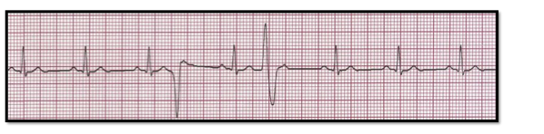 <p></p><p>Identify the above waveform:</p><p>a. unifocal PVCs</p><p>b. Trigeminy</p><p>c. Torsades</p><p>d. multifocal PVCs</p>