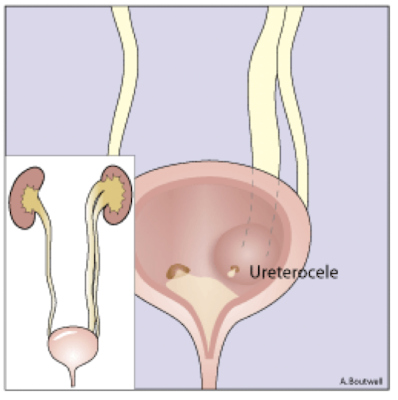 <ul><li><p>cystic dilation of intravesical (bladder) segment of distal ureter</p></li><li><p>often found in duplex collecting systems</p><ul><li><p>ureter attached to ureterocele in duplex collecting system drains upper pole of kidney as it enters bladder in more medial and caudal position (ectopic ureter)</p></li></ul></li><li><p>females are more likely to present with ureteroceles</p></li><li><p>unilateral or bilateral</p></li></ul><p></p>