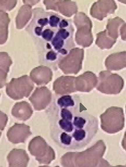 <p>More than 5 lobes in the nucleus</p><ul><li><p>chronic pus forming lesions </p></li></ul><p></p>
