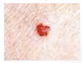 <p>-middle-aged to elderly; develop with aging</p><p>-multiple small red blots, classically on the trunk</p>