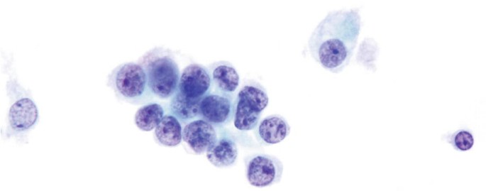 <p>1) Critère obligatoire pour atypies légères selon critères de Paris (uro) </p><p>2) Quelle est la conduite devant atypies légères </p>