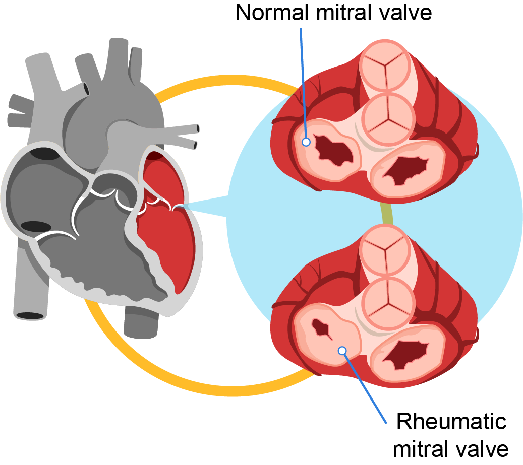 <p>A heart condition caused by damage to the heart valves after rheumatic fever (a complication of untreated streptococcal throat infection).</p>