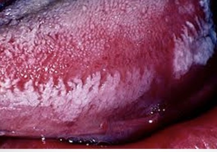 <p><span><span>This lesion is caused by the Epstein Barr virus.</span></span></p><p><span><span>What is it?</span></span></p>