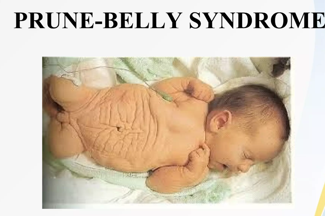 <p>prune belly syndrome</p><p>aka eagle-barret syndrome</p>