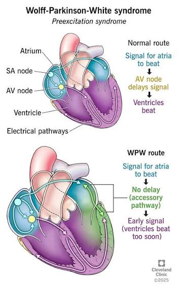 <p>Wolff-Parkinson-White Syndrome (WPW)</p>
