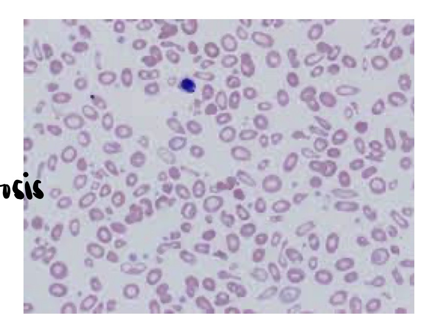 <p>What is Beta thalassemia </p>