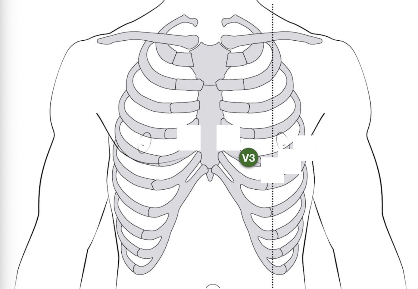 <p>V3 placement - 12-lead EKG</p>
