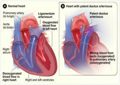 <p>More common in prematurity, 3-8 per 10,000 live births, more female and AA, maternal rubella, genetic conditions</p><p>*normal anatomical ft for a fetus, should go away though</p>