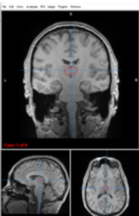 <p>medial geniculate nucleus</p>