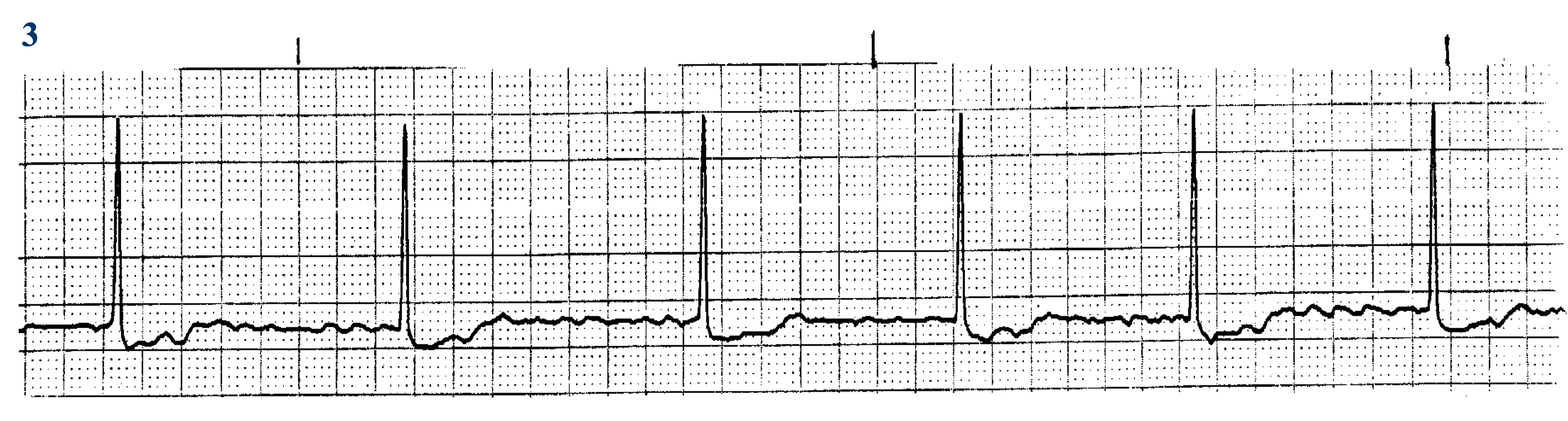 <p>What ECG is this? </p>