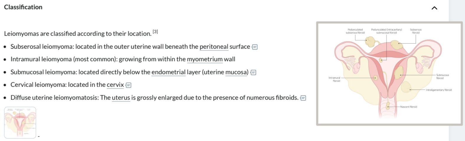 <p>Benign uterine tumour primarily composed of smooth muscle and fibrous connective tissue</p><ul><li><p>Round, firm, and well-circumscribed nodules</p></li><li><p>Located either <em>submucosal </em>(beneath endometrium), <em>intramural </em>(within uterine wall), or <em>subserosal </em>(beneath peritoneum)</p></li></ul><p><strong>Sx</strong>: <em>mostly asympt.</em>, excess uterine bleeding → anaemia/menorrhagia, back/abdo/pelvic pain, bowel/urine sx miscarriage/infertility (distorted uterine cavity)</p><p><strong>RF</strong>: obesity, age 25-40yrs, nulliparity, early menarche, African Americans</p><p></p><p><strong><u>First Line</u></strong>: Exam (enlarged irregular uterus, irregular firm pelvic mass on bimanual exam)</p><p><strong><u>Gold Standard</u></strong>: Pelvic US (well circumscribed uterine tumours), Endometrial Biopsy, Hysteroscopy</p><p><strong>Other:</strong> MRI pelvis ± IV contrast (characterise leiomyomas), Sonohysterography, Bloods (CBC, BMP, Urine preg.; Abn. Bleeding = PT, PTT, fibrinogen, TSH, LFTs, von Will disease studies)</p>