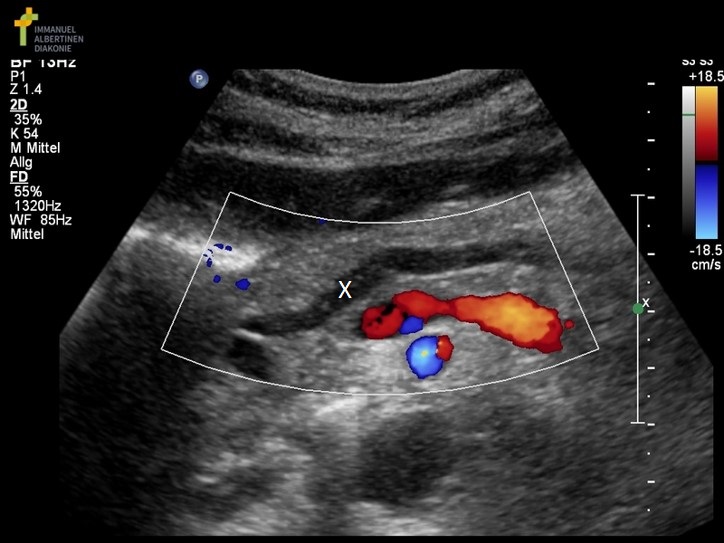 <p>What structure is marked with the X on the image?</p>