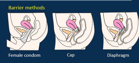 <ul><li><p>Female condom</p></li><li><p>Cap</p></li><li><p>Diaphragm</p></li></ul><p></p>