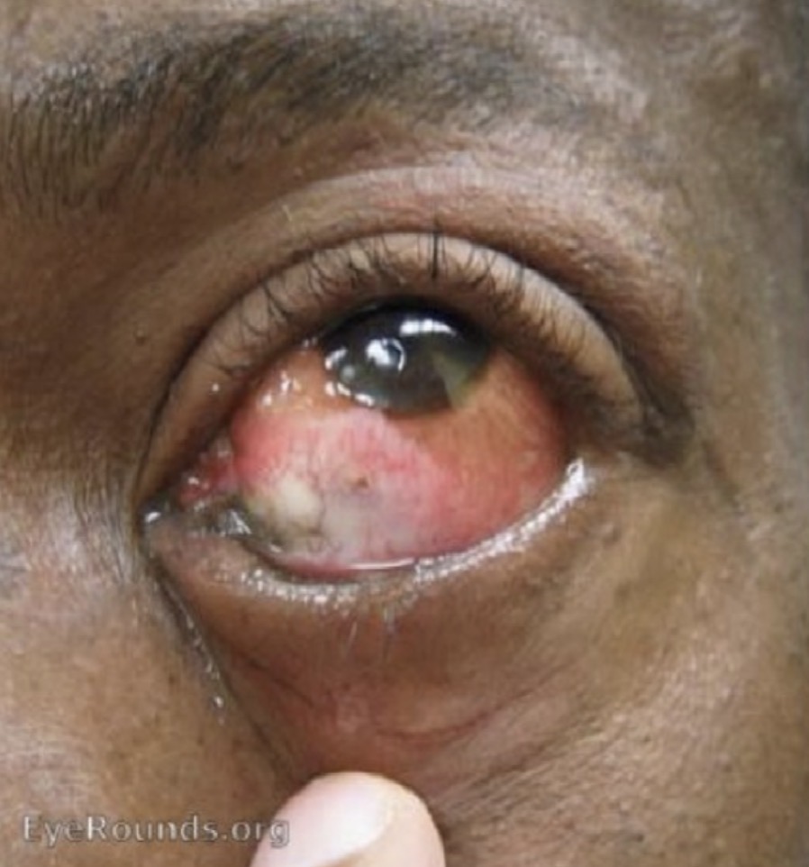 <p><span>Un homme de 26 ans se présente à l'urgence après avoir reçu des éclaboussures d'un nettoyant à plancher (pH 10) à son œil gauche à l'usine où il travaille. Il a tout de suite reçu une irrigation pendant 10 minutes de son œil gauche à la douche oculaire de l'usine. Considérant le pH du nettoyant à plancher, lequel des éléments suivants est FAUX ?</span></p><p></p><p><span>A. ﻿﻿﻿À l'arrivée à l'hôpital, il faut immédiatement vérifier le pH de l'oeil et reprendre l'irrigation jusqu'à normalisation du pH de l'oeil</span></p><p><span>B. Une ischémie limbique (blancheur et perte des vaisseaux au limbe) requiert une référence rapide en ophtalmologie</span></p><p><span>C. ﻿﻿﻿Le traitement d'une brûlure chimique légère comprend un antibiotique topique, un cycloplégique et des corticostéroïdes topiques</span></p><p><span>D. Les produits alcalins coagulent les protéines du stroma cornéen, ce qui limite les dommages</span></p>