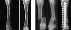 <p>What is this type 3rd metacarpal (cannon) bone fracture? Who commonly gets it?</p>