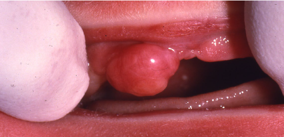 <ul><li><p>rare lesion of underdetermined histogenesis</p></li><li><p><strong>found at birth on the maxillary ridge of girl babies</strong></p></li><li><p>smooth surfaced, often pedunculated, lobulated nodule</p></li><li><p>vary in size</p></li><li><p>the cells are granular histopathological</p></li></ul><p></p>