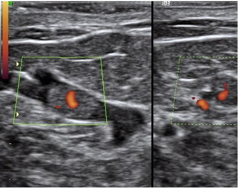 <p>intraductal papilloma</p>