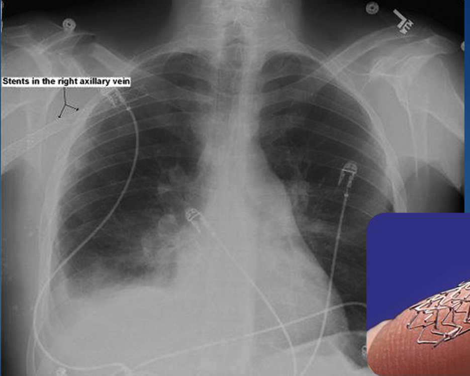 <p>bright, metallic, tubular/cylindrical mesh structures </p>