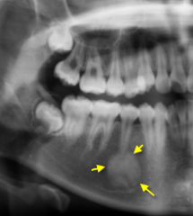 <p>describe the appearance of the lesion:</p>