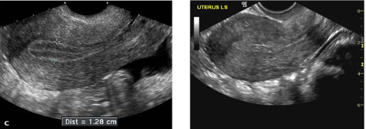<p>What part of the Menstral Cycle this patient is in?</p>