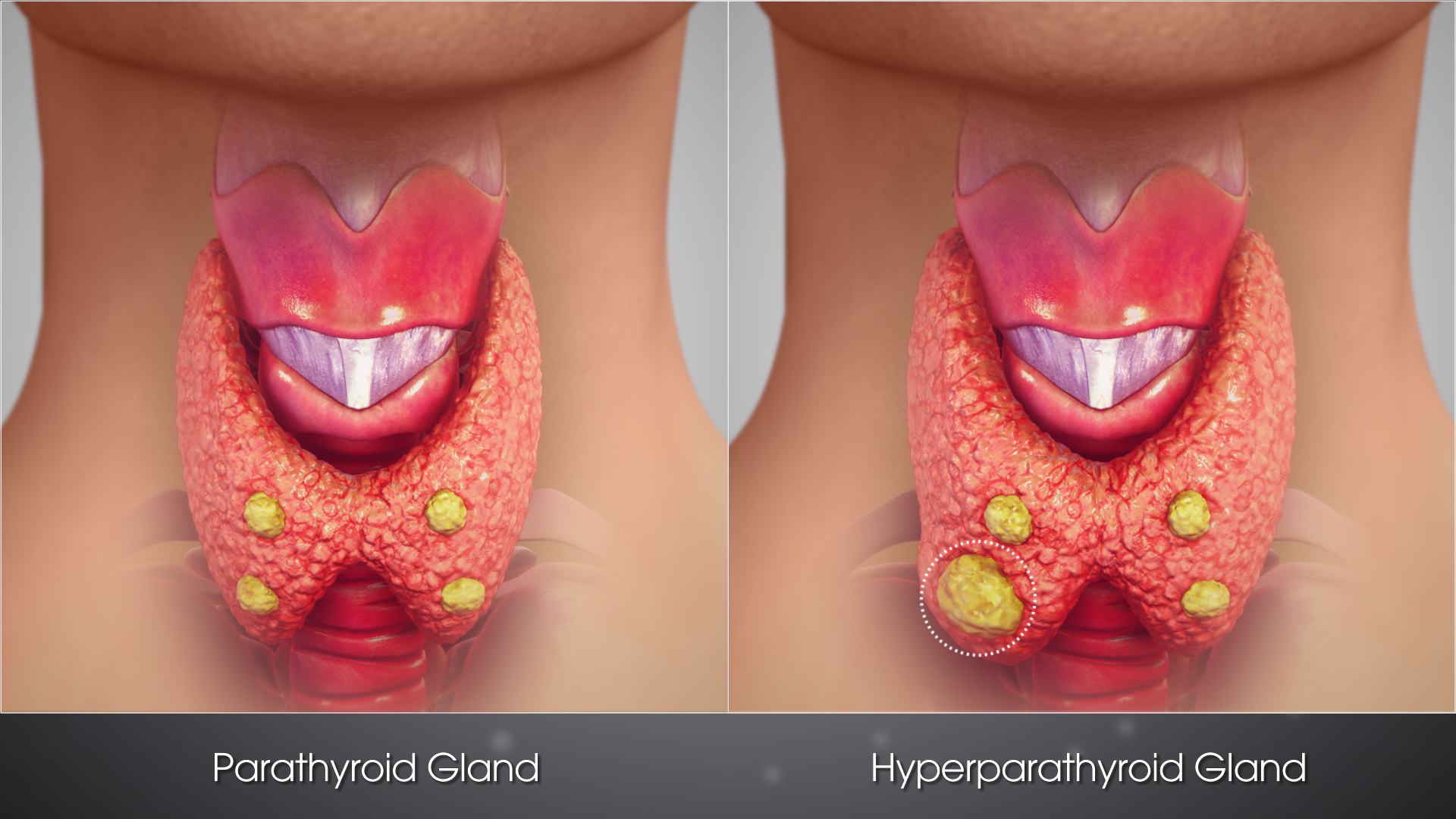 <p><span style="line-height: 107%;"><strong>BOOK:</strong></span></p><p class="MsoNormal"><span>Overproduction of parathyroid hormone by the parathyroid glands, usually caused by a nonmalignant tumor or abnormal growth of the glands. In most cases, there are no symptoms except hypercalcemia but, in more severe cases, weakness, confusion, nausea, and bone pain occur. Bone fractures and kidney stones also are problems.</span></p><p class="MsoNormal"><span style="line-height: 107%;"><strong>SIMPLE:</strong></span></p><p class="MsoNormal">A condition in which the <span style="font-family: Calibri, sans-serif;"><strong>parathyroid glands produce too much parathyroid hormone (PTH)</strong></span>, causing <span style="font-family: Calibri, sans-serif;"><strong>high calcium levels in the blood</strong></span>.</p>