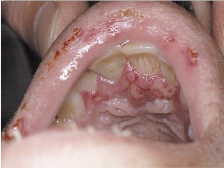 <p>what is this lesion</p>