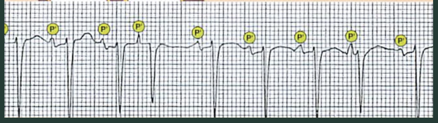 <p>Name the traits of multifocal atrial tachycardia (MAT)?</p>