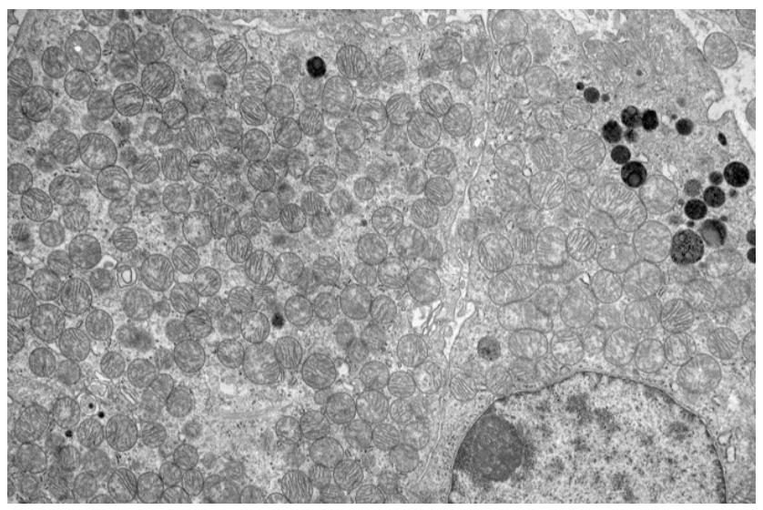 <p>A 50-year-old man undergoes a partial nephrectomy for an incidentally discovered 4 cm renal mass located at the upper pole of the right kidney. Gross examination reveals a well-circumscribed, mahogany-brown tumor with a characteristic central stellate scar. Microscopic examination shows uniform cells arranged in nests and tubules. The tumor cells have abundant granular eosinophilic cytoplasm and small, round, centrally placed nuclei. Special staining is negative for Hale colloidal iron. Electron microscopy of the tumor is shown in the attached image. Which of the following subcellular structures is most likely responsible for the dominant ultrastructural finding in this tumor?</p>