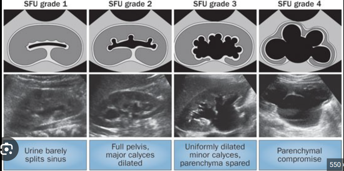 <p>mild - dilation of renal pelvis</p><p>moderate - dilation of pelvis + calices + pyramids</p><p>marked - dilation extends into cortex, thinning of parenchyma</p>
