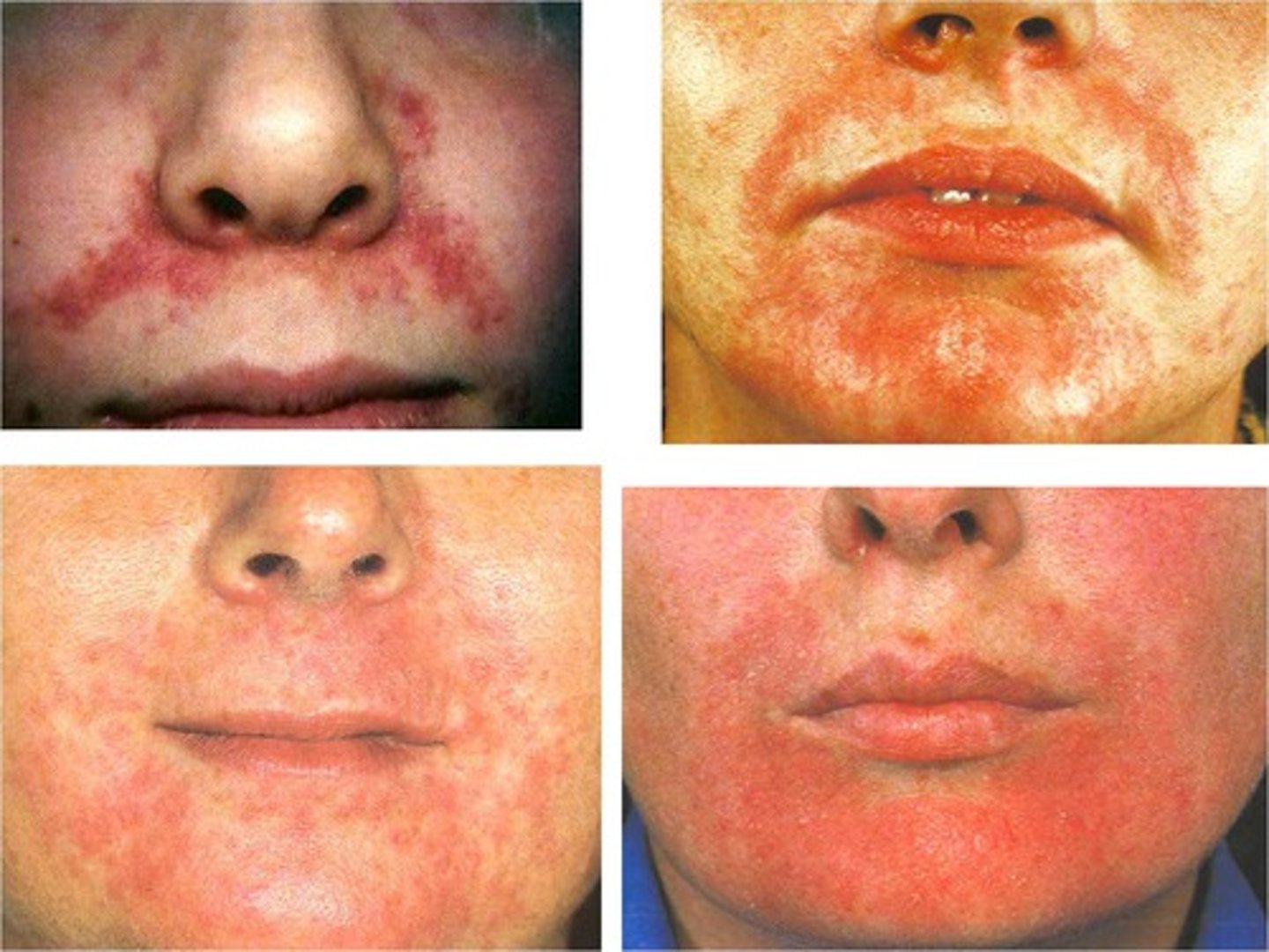 <p>-often mistaken for acne</p><p>- erythematous papules/pustules usually in kids or adult females</p><p>- can be periorbital and/or in alar creases and called periorificial dermatitis</p><p>"cousin to rosacea"</p>
