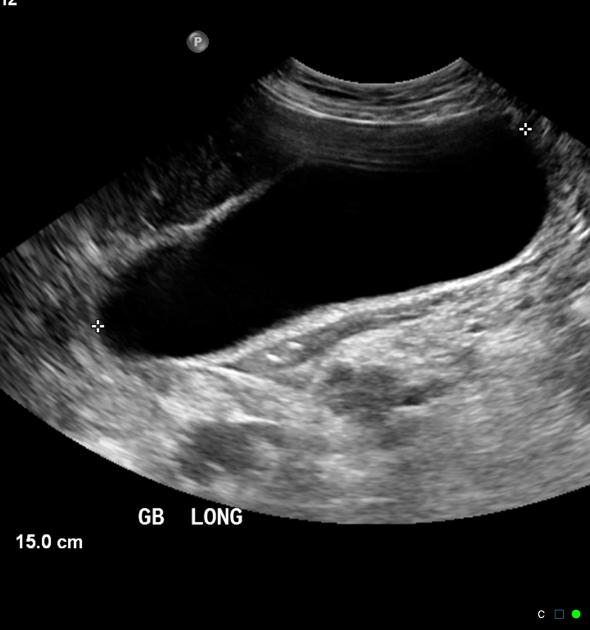 <p>Dilated gallbladder due to obstruction from malignant tumor. NO INFLAMMATION. <br>Can be due to obstructed cystic duct og CBD, last one may lead to dilated intrahepatic biliary tree. </p>